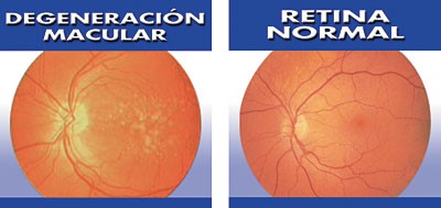 Degeneración molecular y retina normal