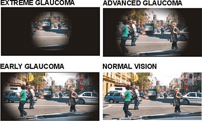 Qué es el glaucoma